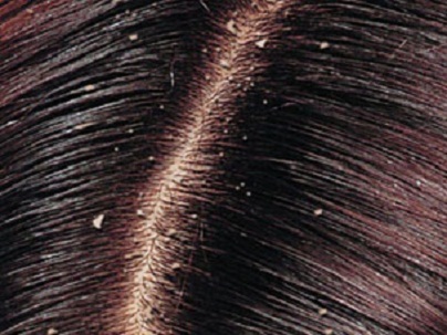 وصفة سهلة لقشرة الشعر
